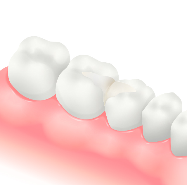 e-maxセラミックインレー