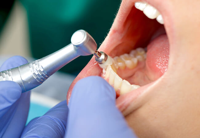 PMTC（プロによるクリーニング）