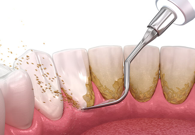 スケーリング（歯石取り）