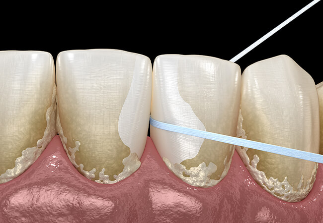 デンタルフロス