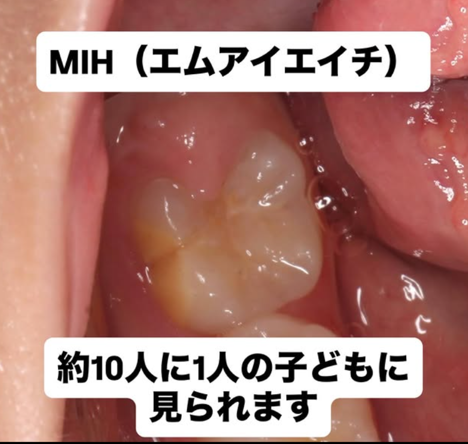 【MIHって知っていますか？】MIH（Molar Incisor Hypomineralization：第一大臼歯・切歯の形成不全