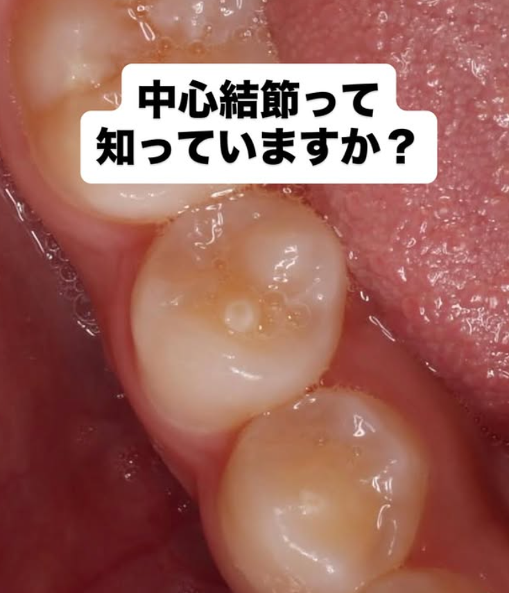 📍中心結節って何？🦷
