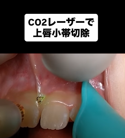 📍前歯のすき間が閉じない原因…実は“上唇小帯”かも？