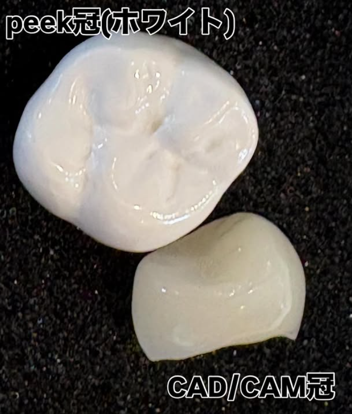 【保険でできる白いかぶせ物、増えてます🦷】