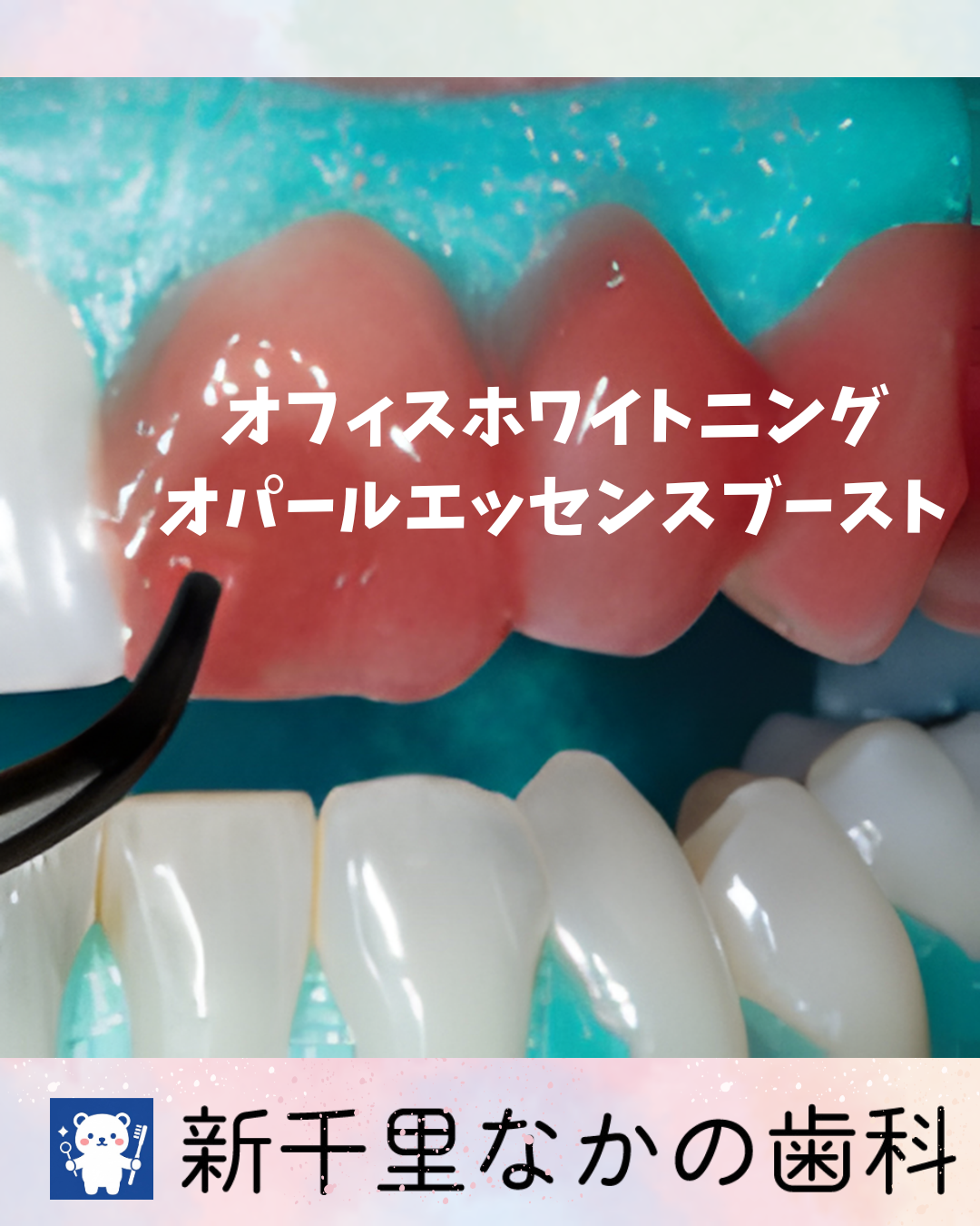 オフィスホワイトニング