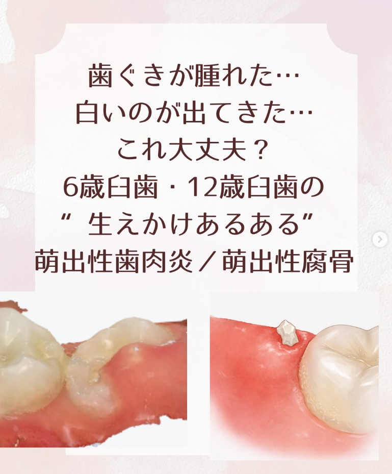 【豊中市小児歯科】6歳臼歯・12歳臼歯の歯ぐきの腫れや白いものが出てきたら|豊中市・千里中央・桃山台