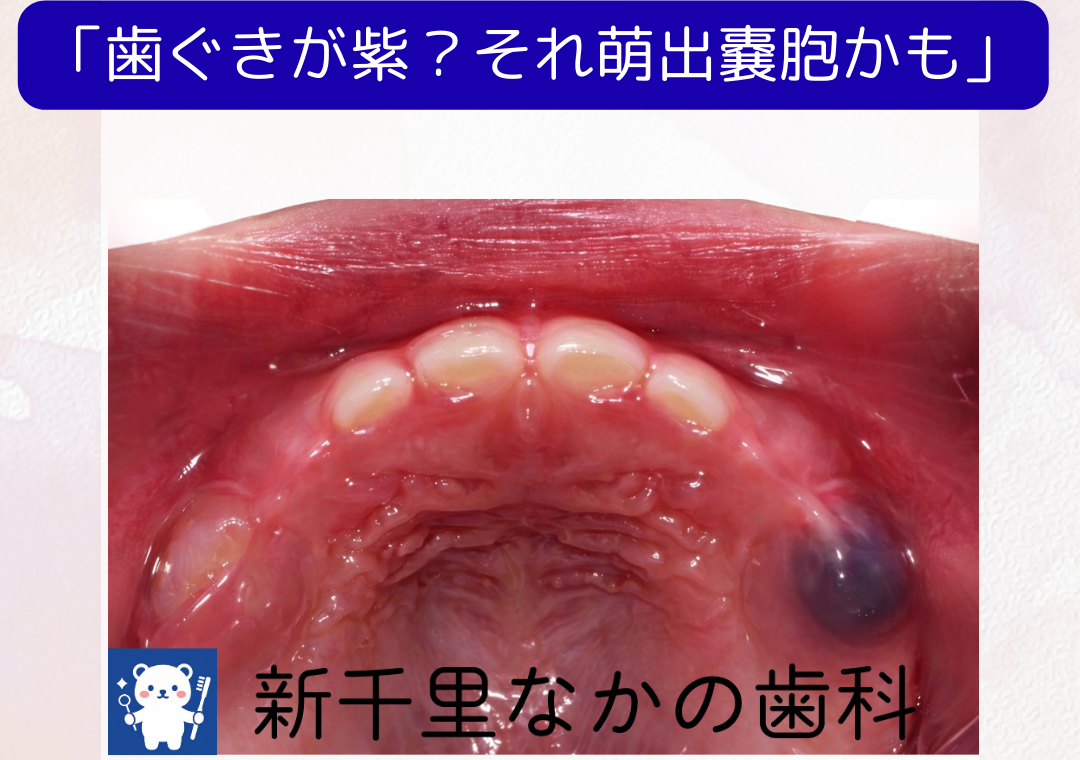 歯ぐきが紫？それは「萌出嚢胞（ほうしゅつのうほう）」かもしれません